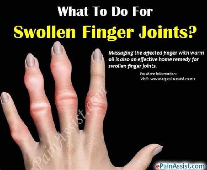 What do you do for a swollen pinky finger?