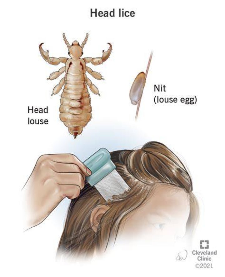 Would I know if I had lice?